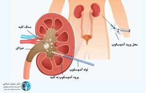 جراحی سنگ کلیه به روش بسته PCNL