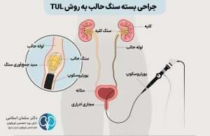 جراحی سنگ حالب به روش اندوسکوپی (TUL)
