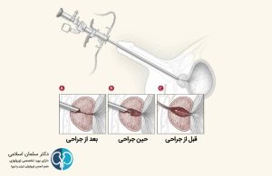 جراحی اندوسکوپی پروستات