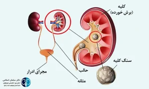 سنگ کلیه